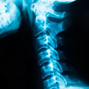 spinalkanalstenose_halswirbelsaeule_inhaltsbild_zoom