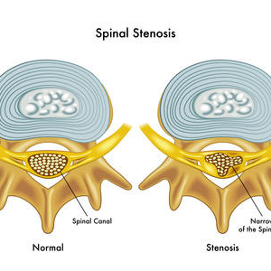 SPINALKANALSTENOSE